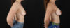 Breast Augmentation case #6491 slider thumbnail