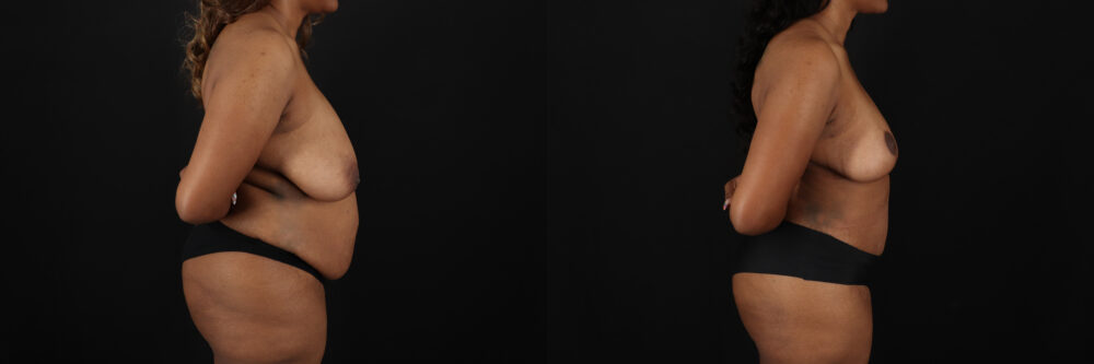 Post Bariatric Surgery (Massive Weight Loss) case #6782