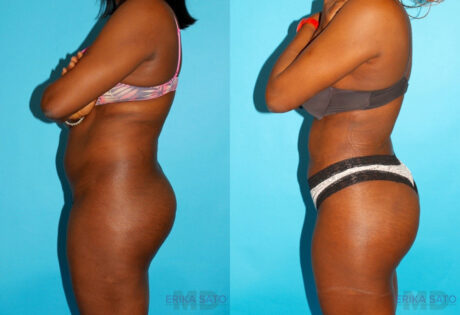 Brazilian Butt Lift case #4762