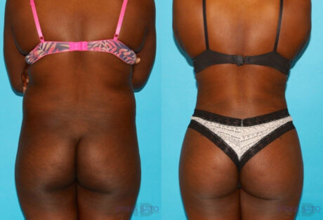 Brazilian Butt Lift case #4762