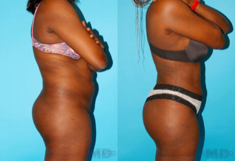 Brazilian Butt Lift case #4762