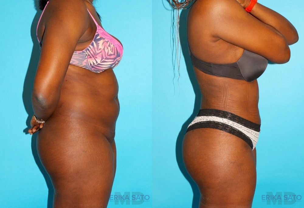 Brazilian Butt Lift case #4762