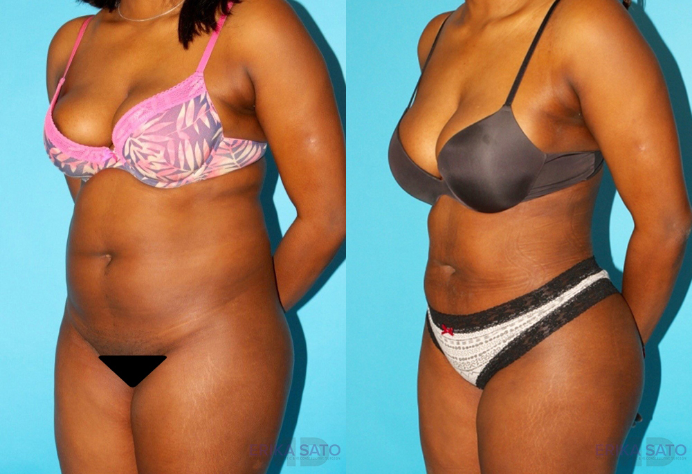 Brazilian Butt Lift case #4762