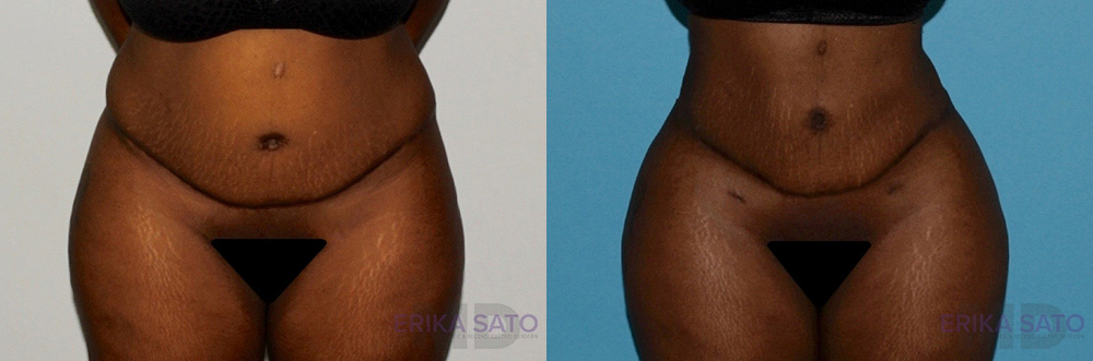 Brazilian Butt Lift case #4445