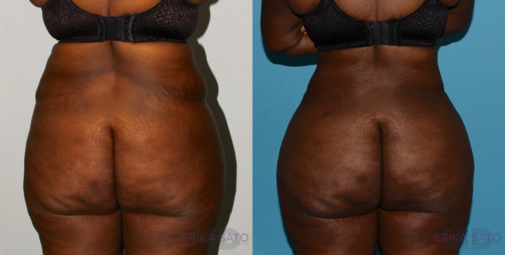 Brazilian Butt Lift case #4445