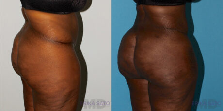 Brazilian Butt Lift case #4445