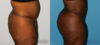 Brazilian Butt Lift case #4445 slider thumbnail