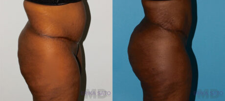 Brazilian Butt Lift case #4445