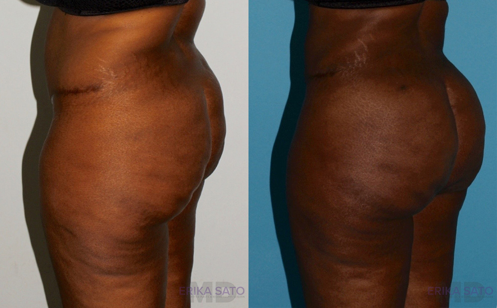 Brazilian Butt Lift case #4445