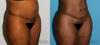 Brazilian Butt Lift case #4445 slider thumbnail