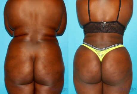 Brazilian Butt Lift case #4672