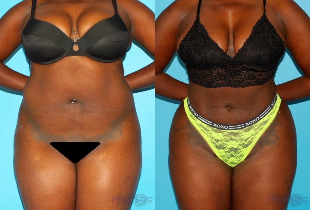 Brazilian Butt Lift case #4672