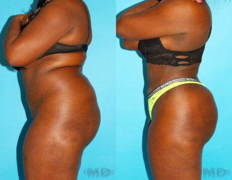 Brazilian Butt Lift case #4672