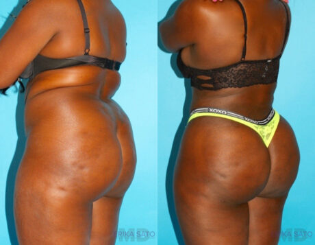 Brazilian Butt Lift case #4672