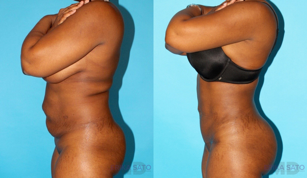 Tummy Tuck case #7168