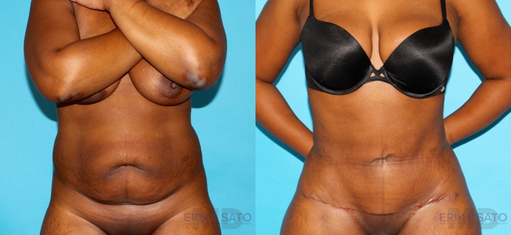 Tummy Tuck case #7168