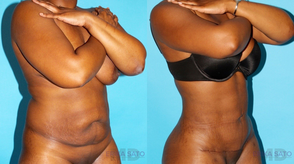 Tummy Tuck case #7168