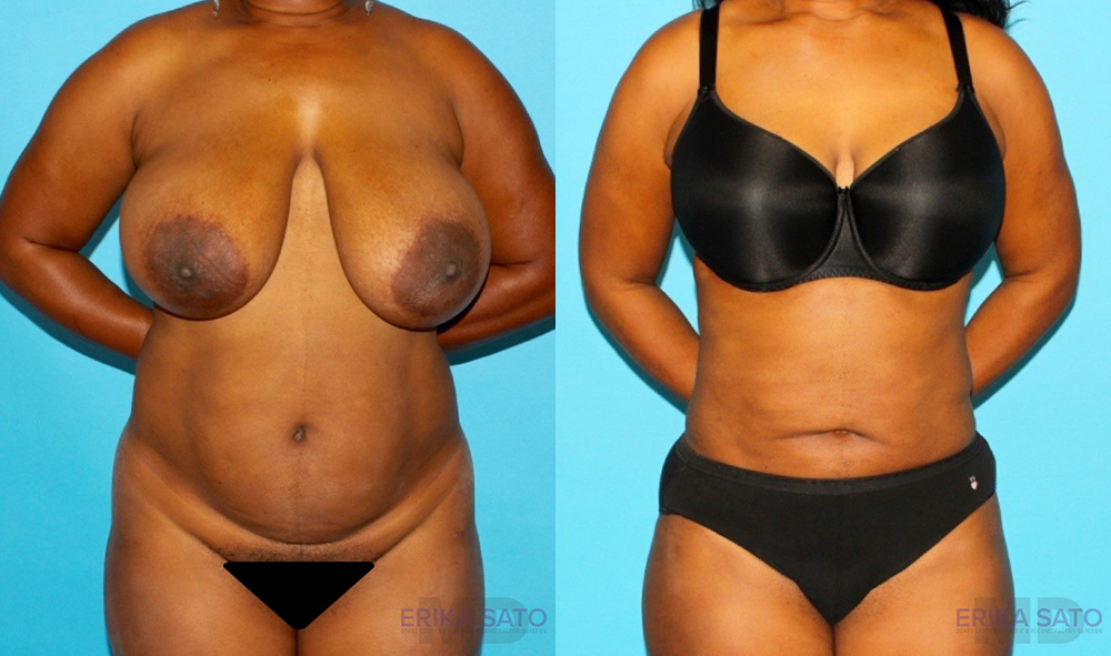 Liposuction case #5888
