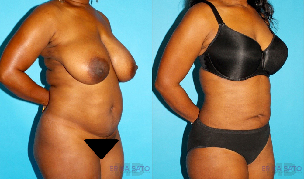 Liposuction case #5888