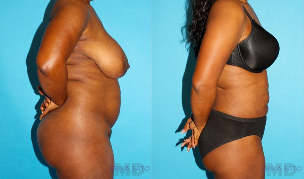 Liposuction case #5888