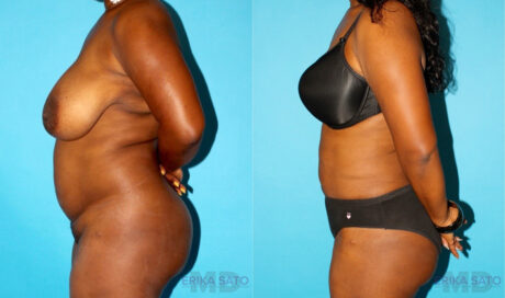 Liposuction case #5888