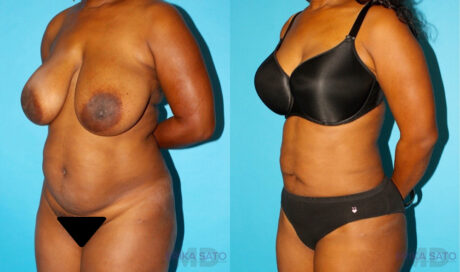 Liposuction case #5888