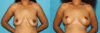 Breast Lift case #6977 slider thumbnail