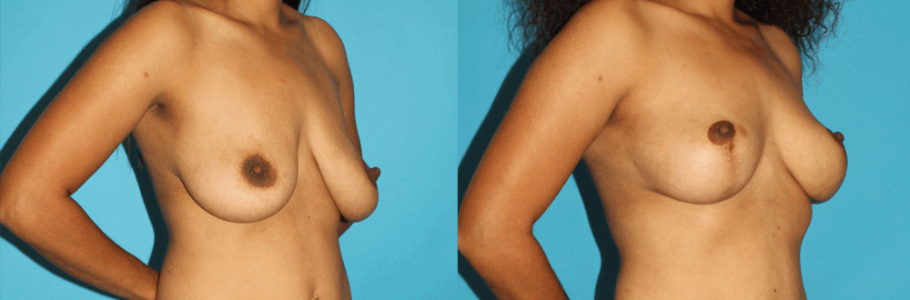 Breast Lift case #6977