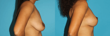 Breast Lift case #6977