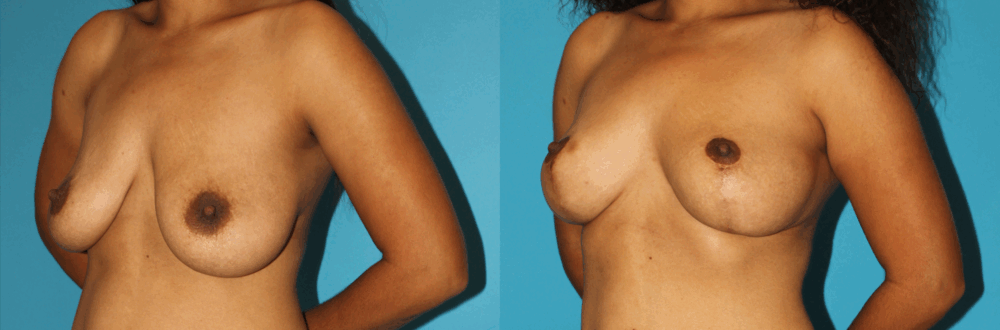 Breast Lift case #6977