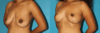 Breast Lift case #6977 slider thumbnail