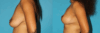 Breast Lift case #6977 slider thumbnail