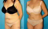 Liposuction case #5887 slider thumbnail