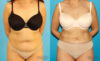 Liposuction case #5887 slider thumbnail