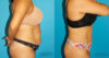 Tummy Tuck case #7274 slider thumbnail