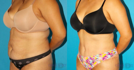 Tummy Tuck case #7274