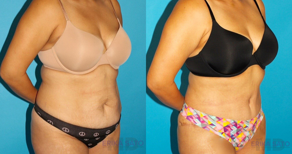 Tummy Tuck case #7274