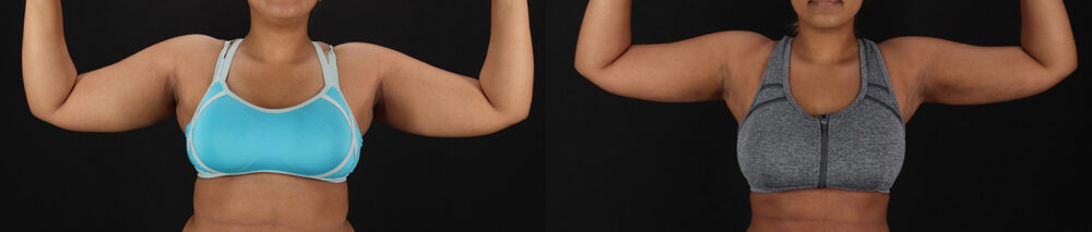 Brazilian Butt Lift case #5513