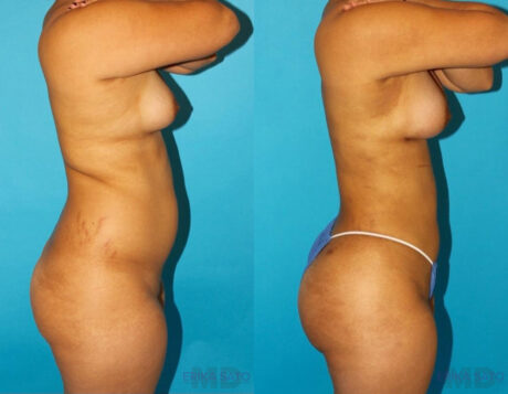 Brazilian Butt Lift case #4763