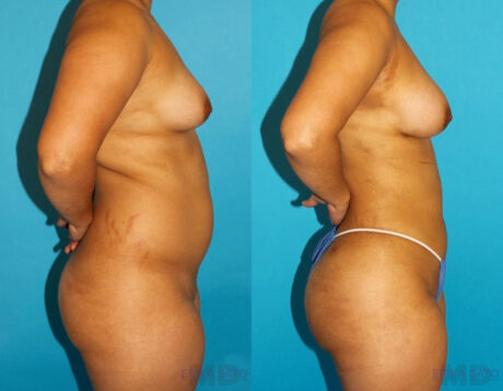 Brazilian Butt Lift case #4763