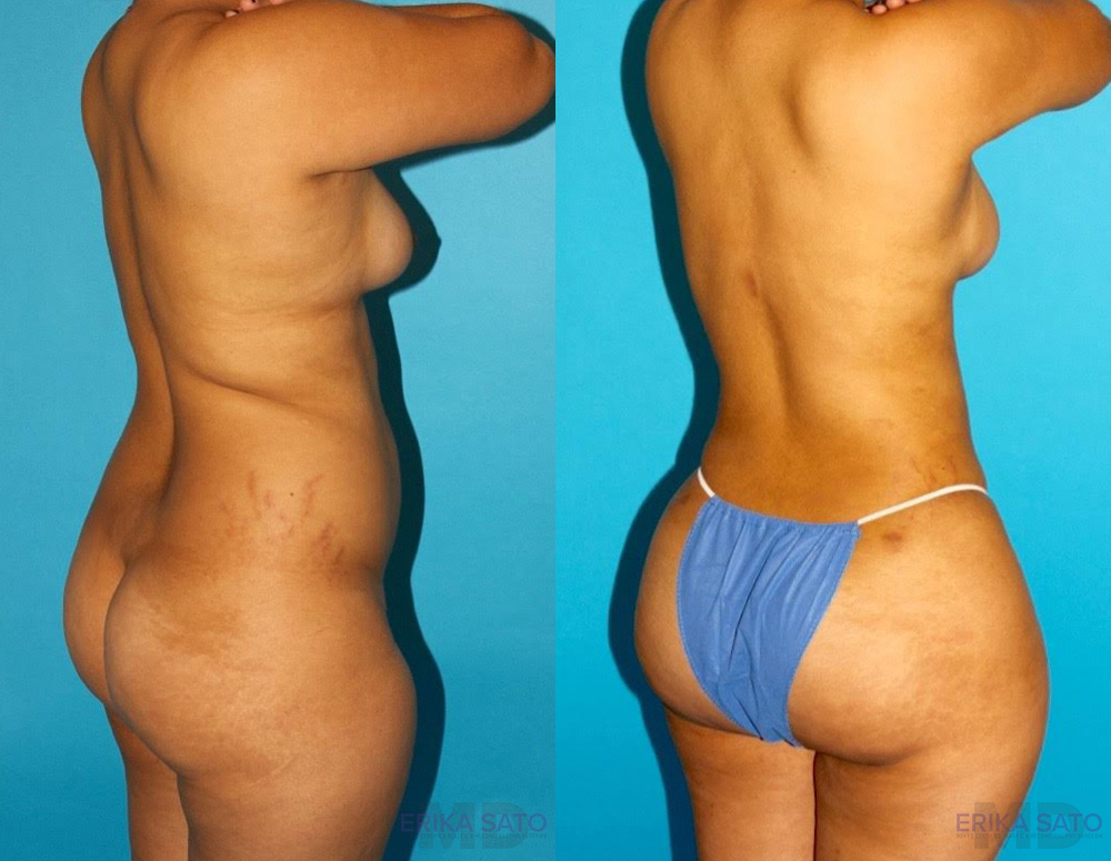Brazilian Butt Lift case #4763