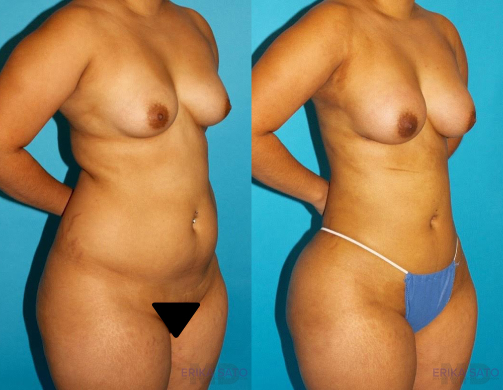 Brazilian Butt Lift case #4763