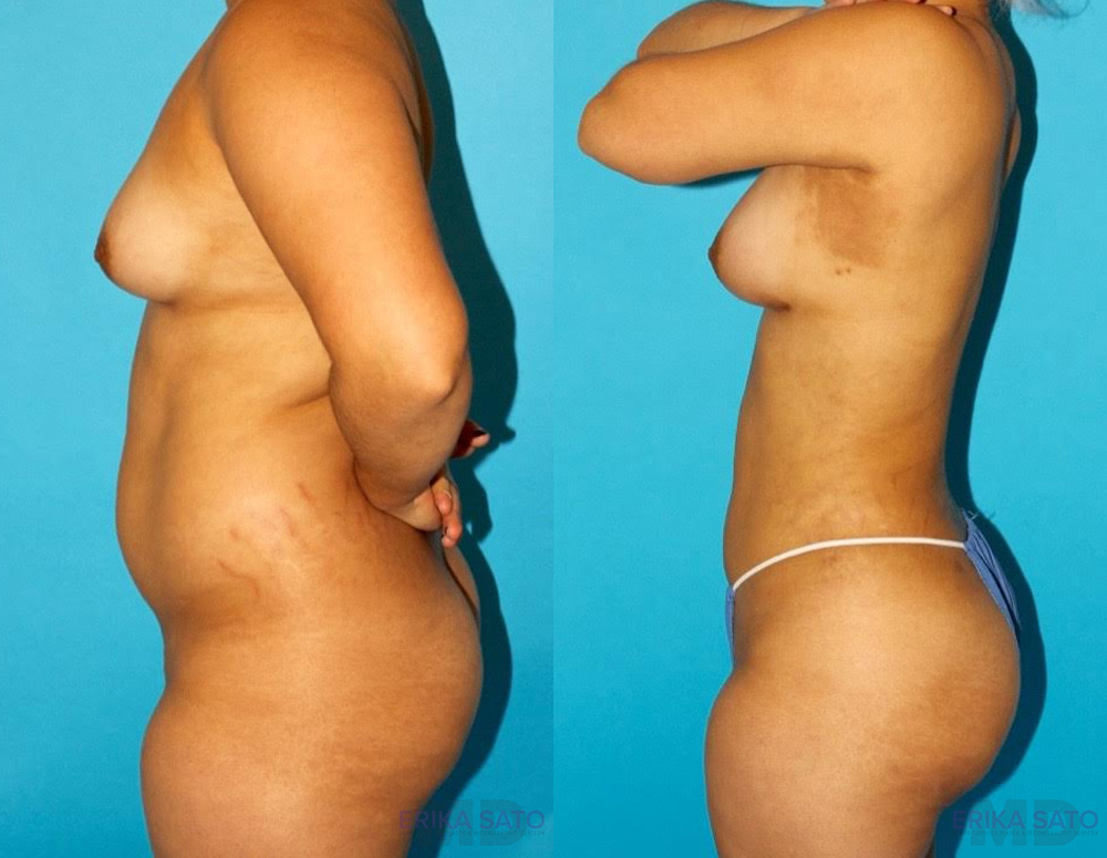 Brazilian Butt Lift case #4763