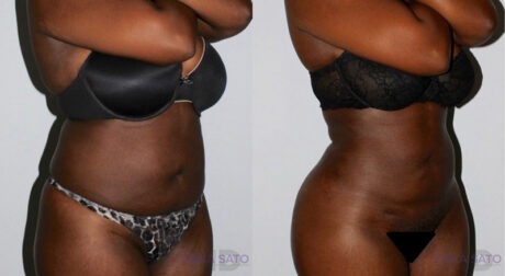 Brazilian Butt Lift case #4625