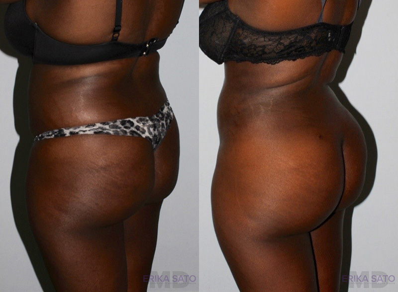 Brazilian Butt Lift case #4625