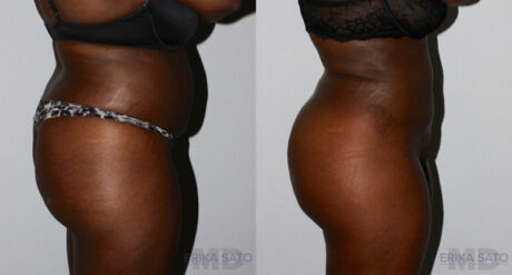 Brazilian Butt Lift case #4625