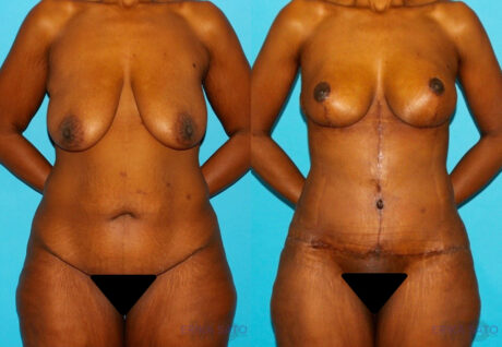 Post Bariatric Surgery (Massive Weight Loss) case #6776