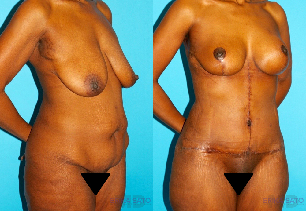 Post Bariatric Surgery (Massive Weight Loss) case #6776