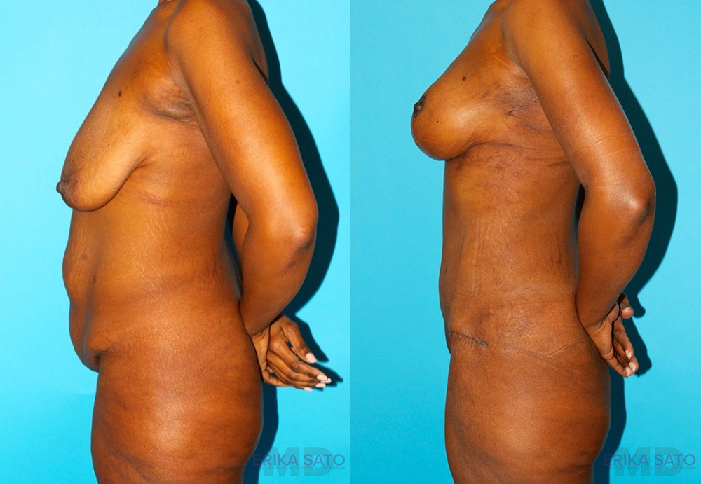 Post Bariatric Surgery (Massive Weight Loss) case #6776