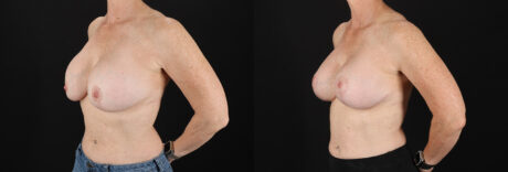 Revision Breast Surgery case #256267